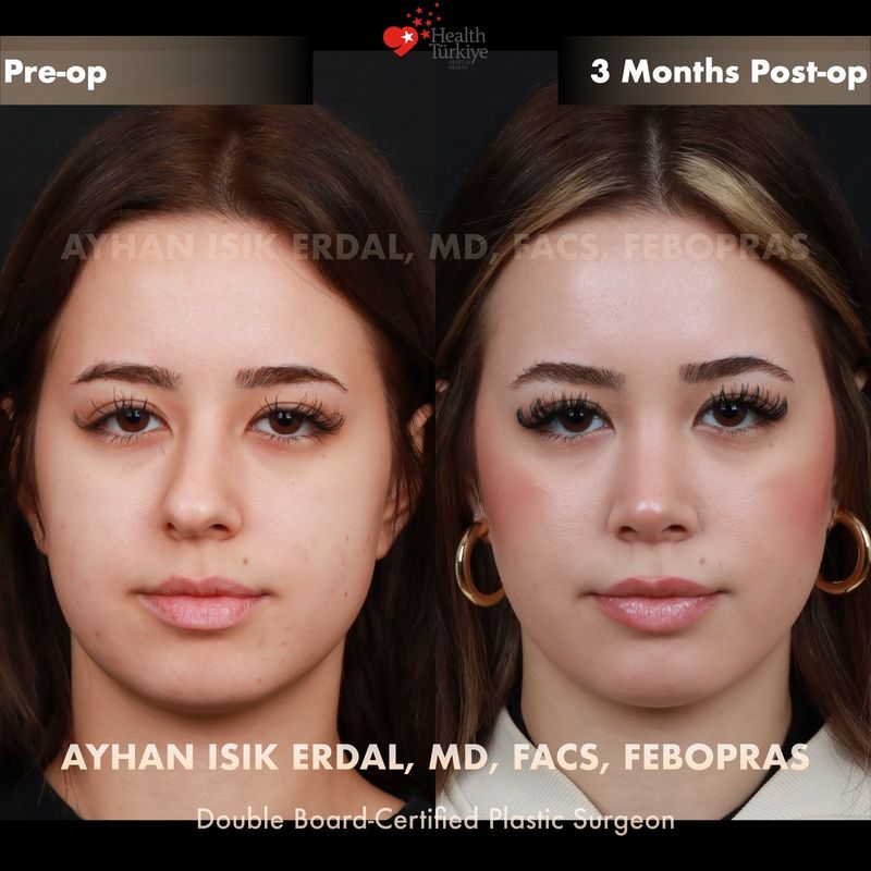 Dorsal preservation rhinoplasty Turkey before and after — female patient frontal view, 3 months post-op