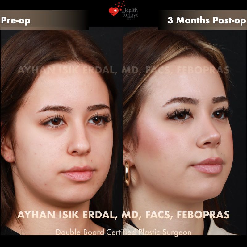 Dorsal preservation rhinoplasty Turkey before and after — female patient oblique view, 3 months post-op