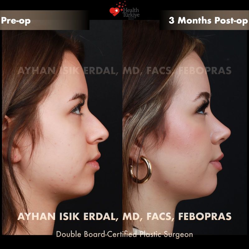 Dorsal preservation rhinoplasty Turkey before and after — female patient profile view, 3 months post-op