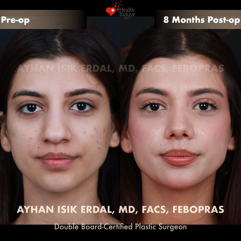 Dorsal preservation rhinoplasty results — female patient frontal view, 8 months post-op