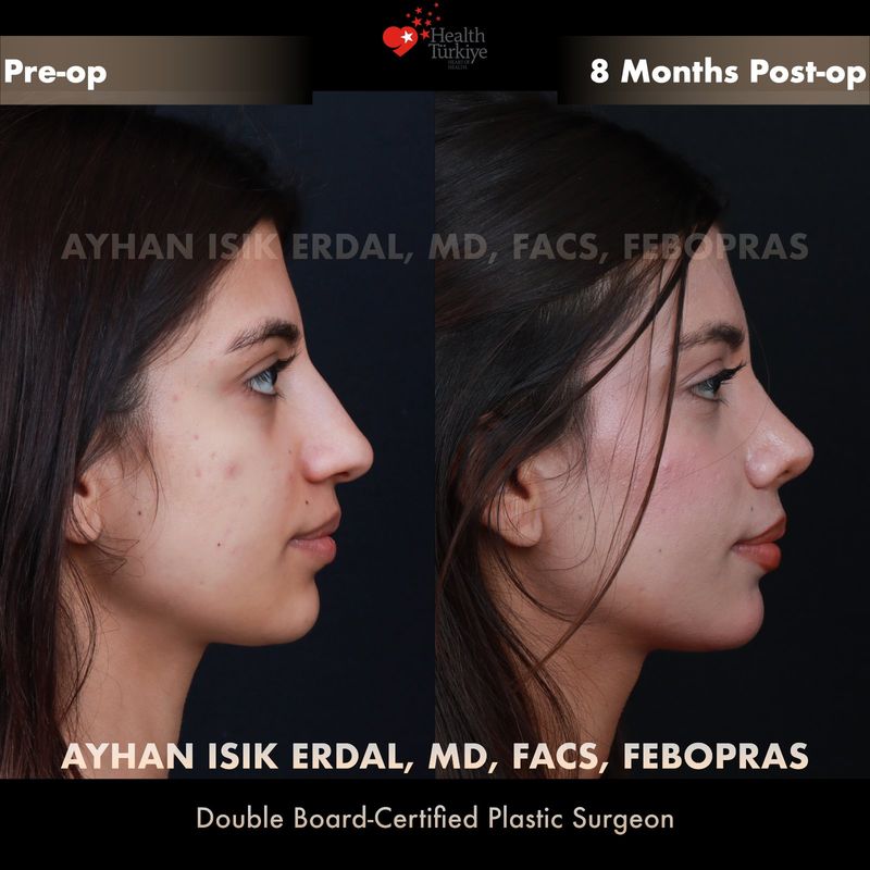 Dorsal preservation rhinoplasty results — female patient oblique view, 8 months post-op