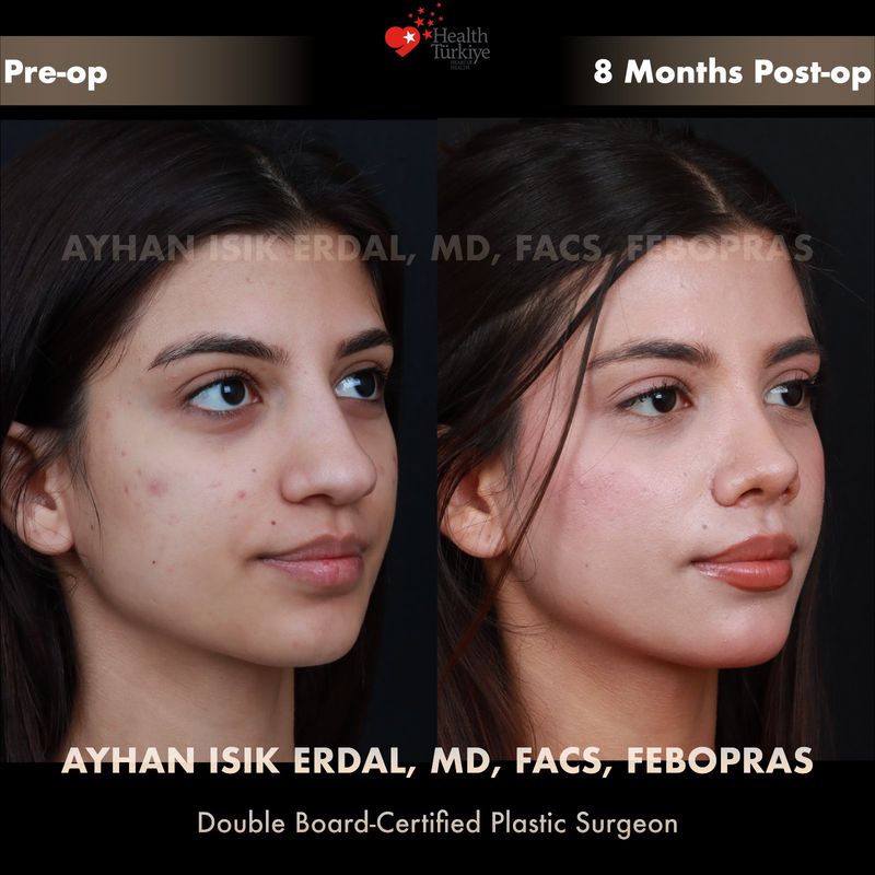 Dorsal preservation rhinoplasty results — female patient profile view, 8 months post-op