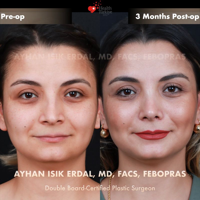 Natural rhinoplasty Turkey results — female patient frontal view