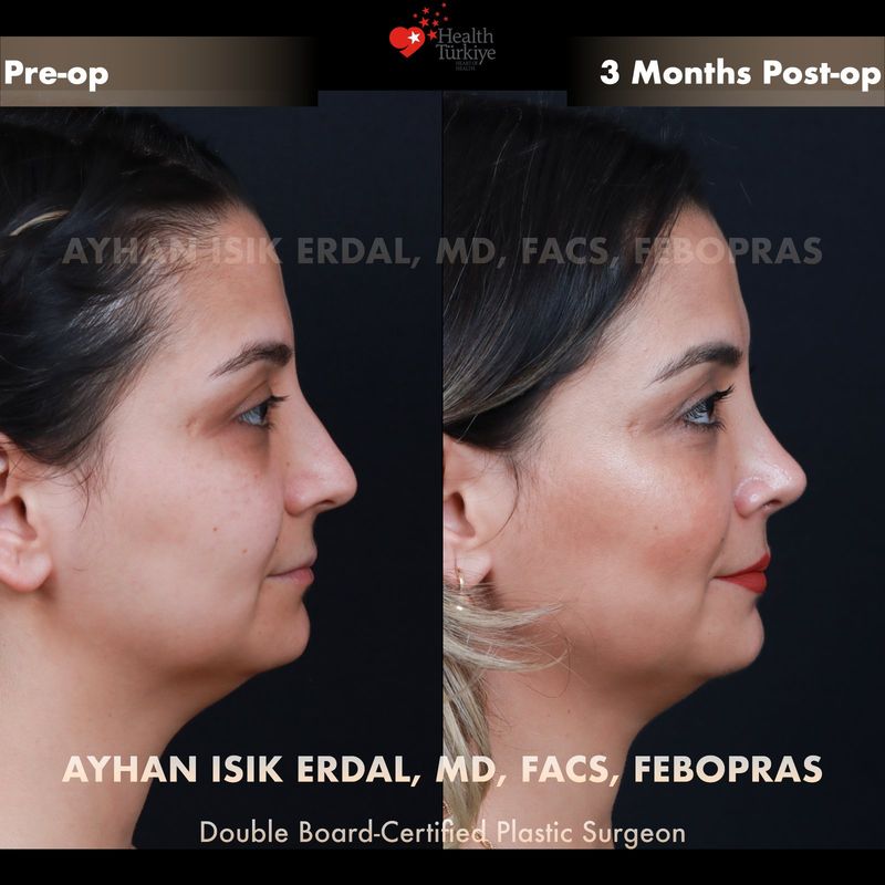 Natural rhinoplasty Turkey results — female patient oblique view