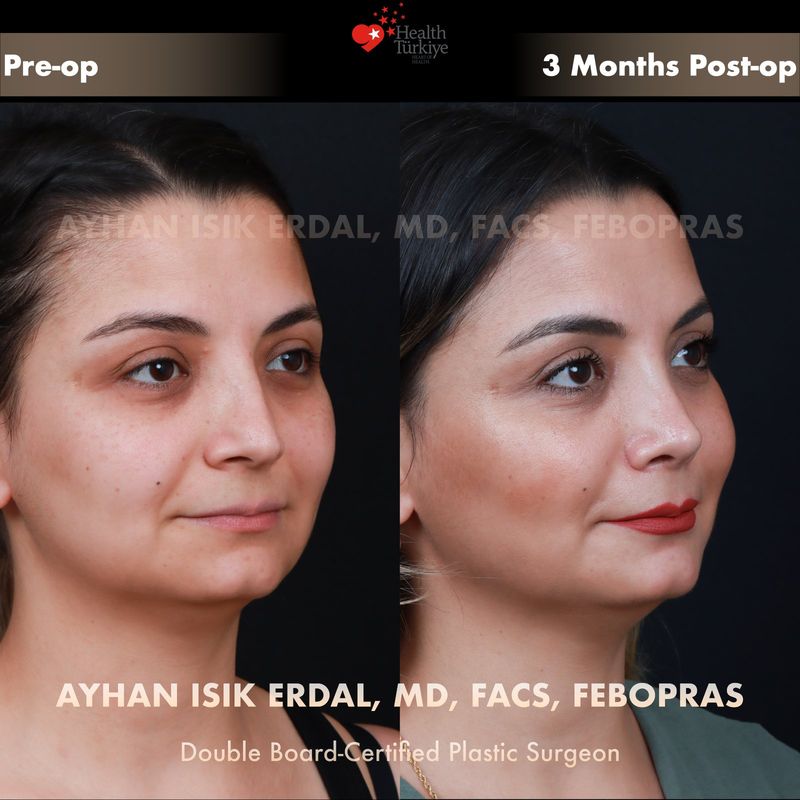 Natural rhinoplasty Turkey results — female patient profile view