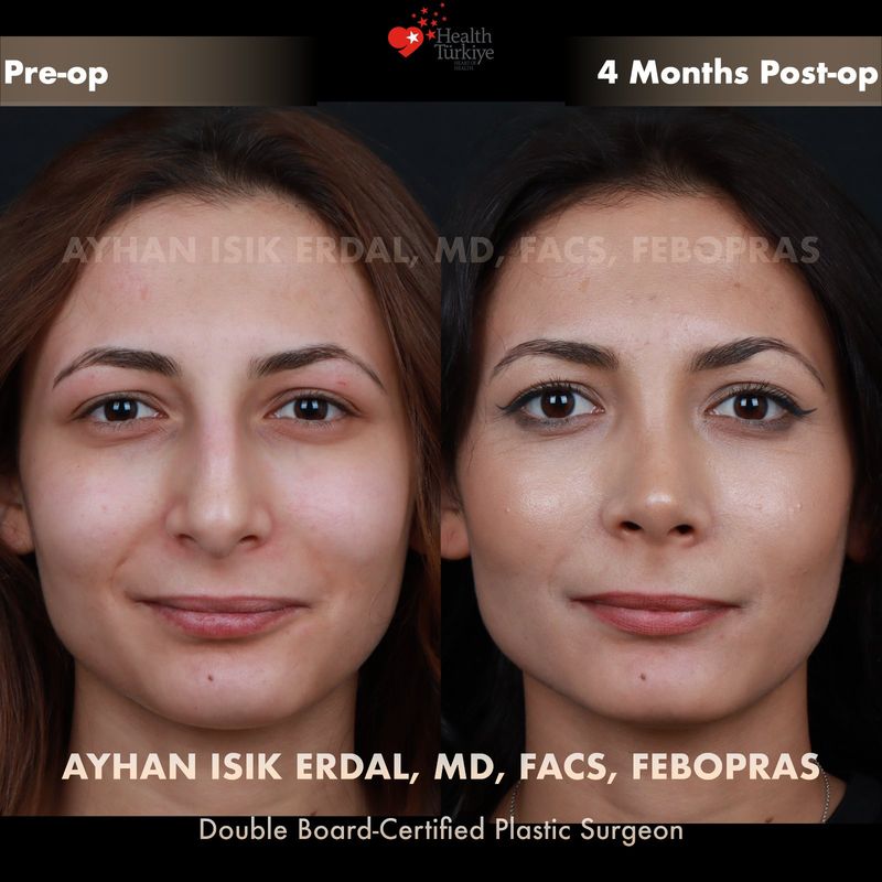 Preservation rhinoplasty before and after — female patient frontal view, 4 months post-op