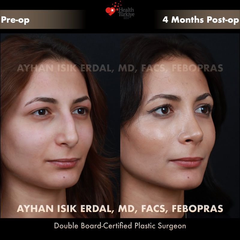 Preservation rhinoplasty before and after — female patient oblique view, 4 months post-op