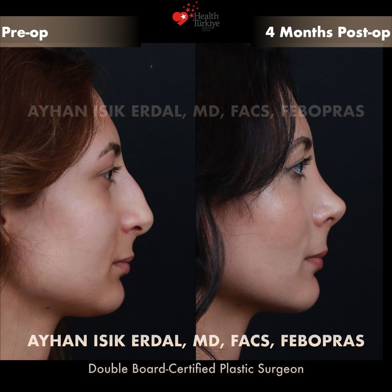 Preservation rhinoplasty before and after — female patient profile view, 4 months post-op