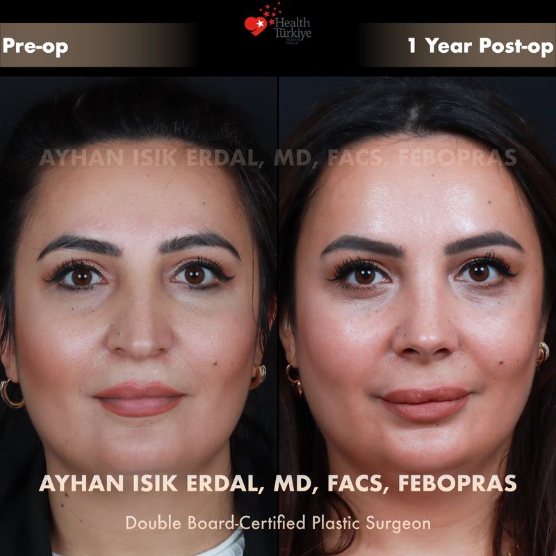 Preservation rhinoplasty before and after — female patient frontal view