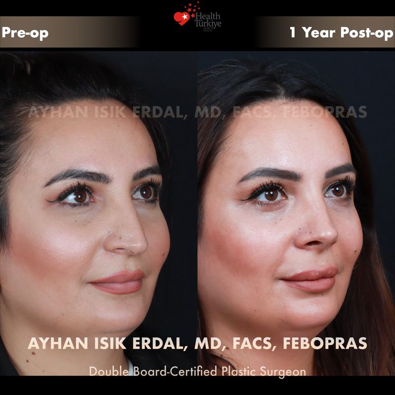 Preservation rhinoplasty before and after — female patient oblique view