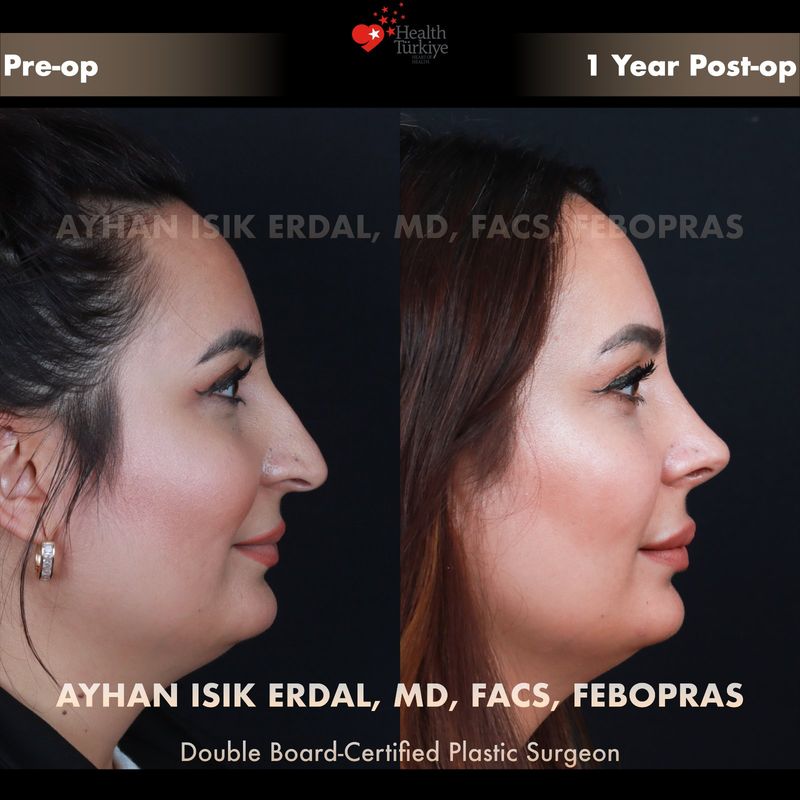 Preservation rhinoplasty before and after — female patient profile view