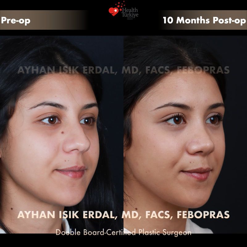 Male preservation rhinoplasty before and after — oblique view, 4 months post-op