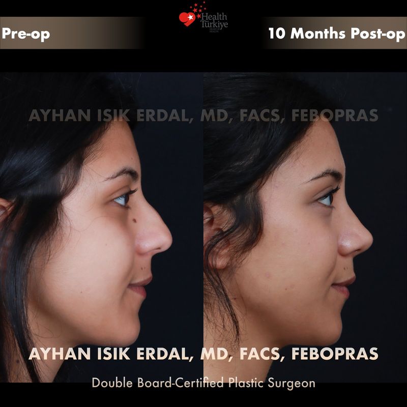 Male preservation rhinoplasty before and after — profile view, 4 months post-op