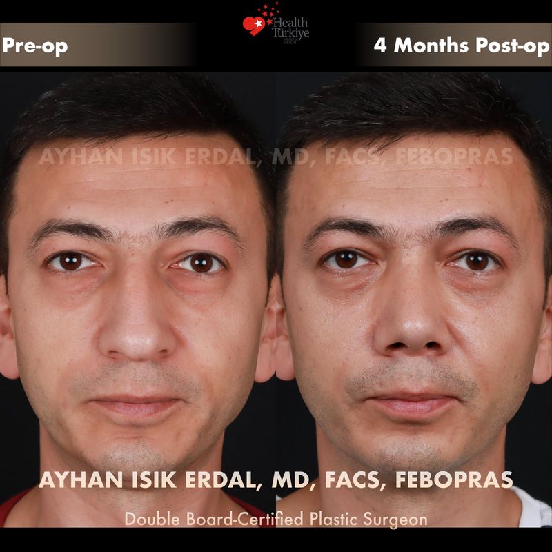 Preservation rhinoplasty Istanbul before after — female patient frontal view, 10 months post-op