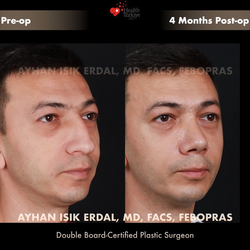 Preservation rhinoplasty Istanbul before after — female patient oblique view, 10 months post-op