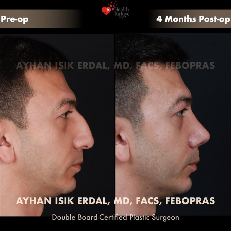 Preservation rhinoplasty Istanbul before after — female patient profile view, 10 months post-op