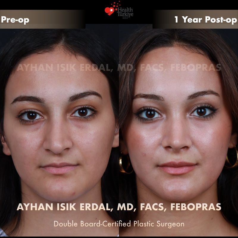 Closed preservation rhinoplasty 1 year result — female patient frontal view