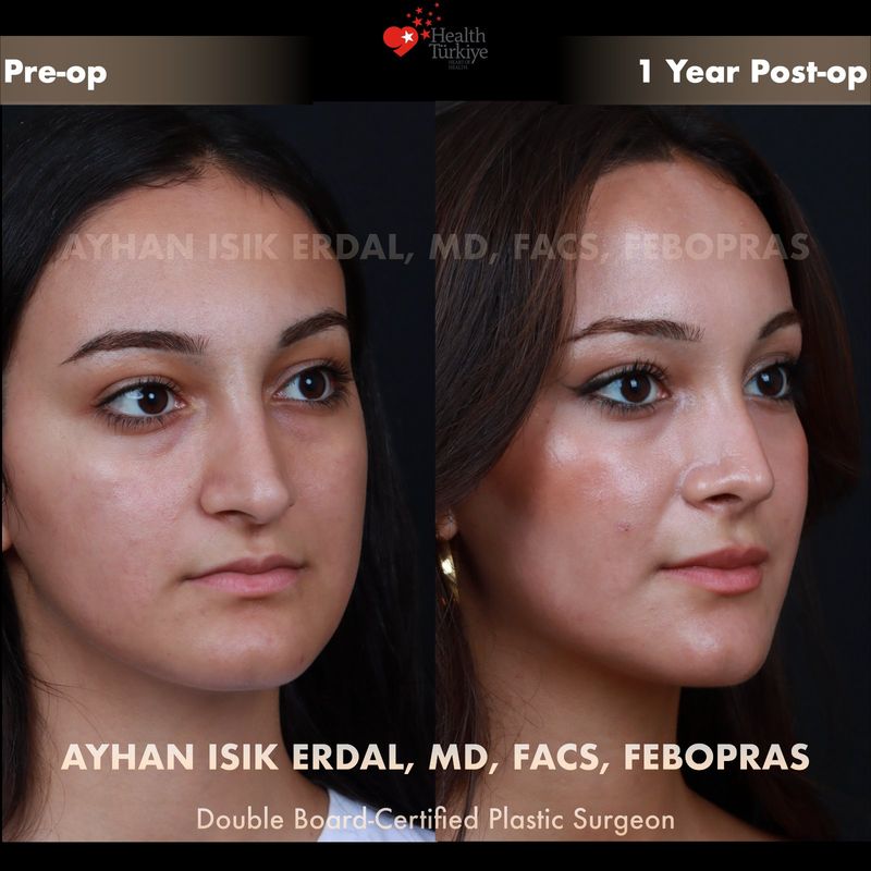 Closed preservation rhinoplasty 1 year result — female patient oblique view