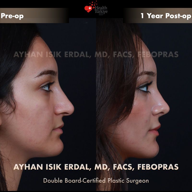 Closed preservation rhinoplasty 1 year result — female patient profile view
