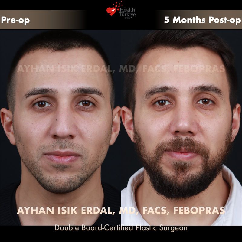 Male preservation rhinoplasty Istanbul — frontal view before after, 5 months post-op