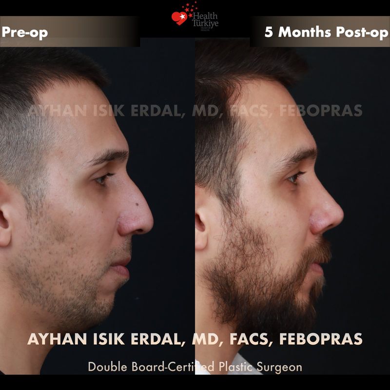Male preservation rhinoplasty Istanbul — oblique view before after, 5 months post-op