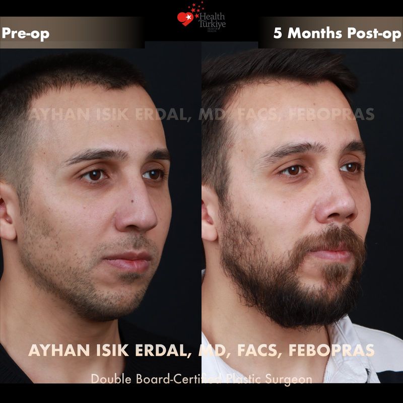 Male preservation rhinoplasty Istanbul — profile view before after, 5 months post-op