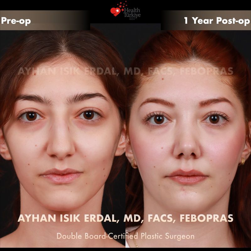 Preservation rhinoplasty before after Istanbul — female patient frontal view, 1 year post-op