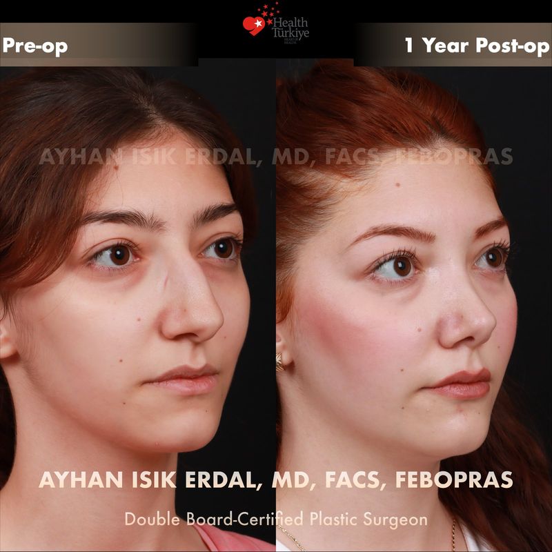 Preservation rhinoplasty before after Istanbul — female patient oblique view, 1 year post-op