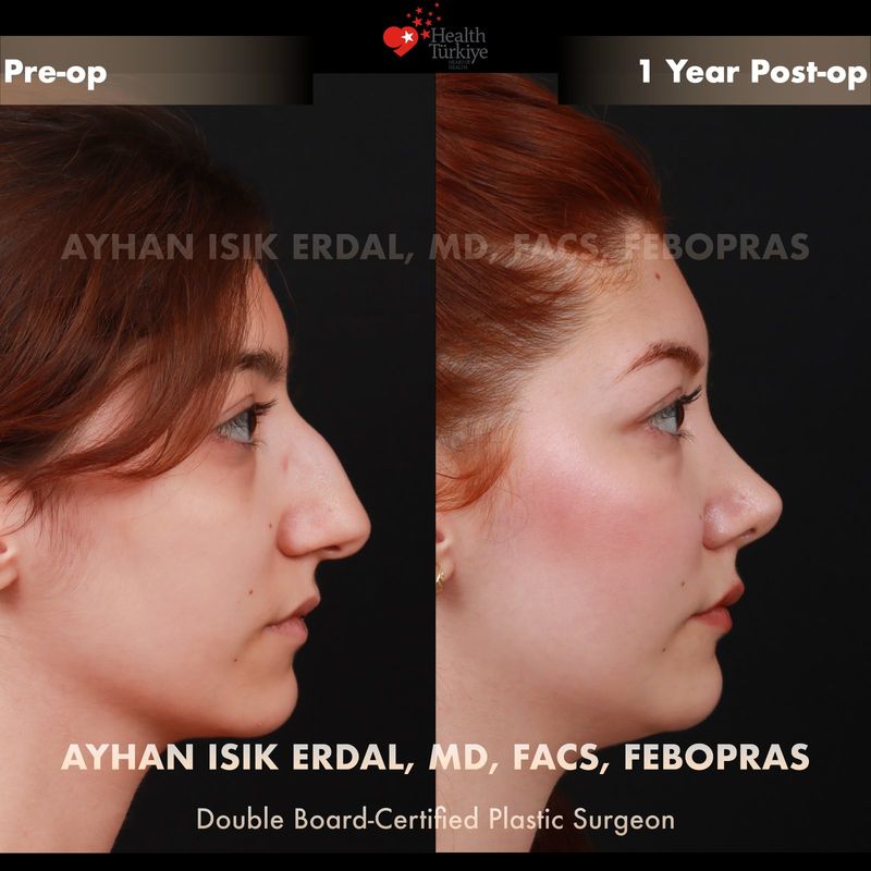 Preservation rhinoplasty before after Istanbul — female patient profile view, 1 year post-op